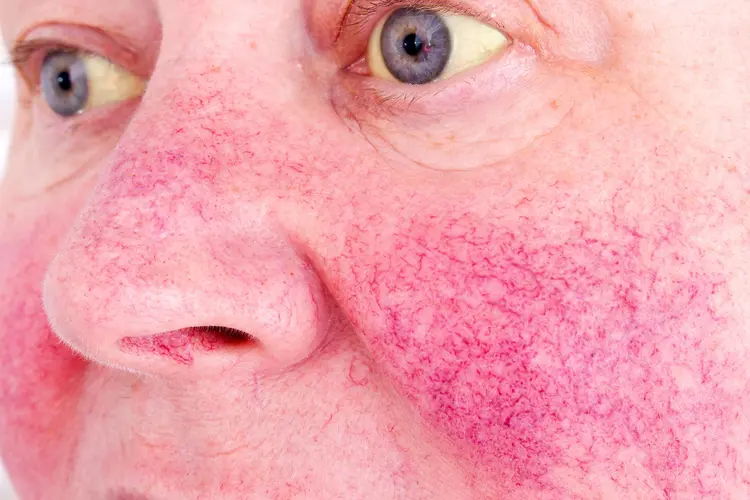Hepatic Face Appearance: Signs, Causes & Simple Steps